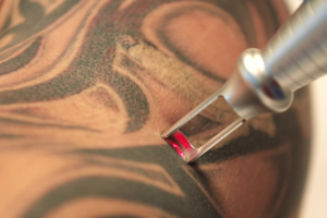 Tattooentfernung Mit Lasertechnik Titelbild Picoplus Lutronic